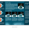 All Laser LASIK Brochure