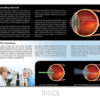 Secondary Cataract Brochure